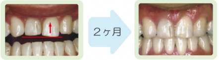 歯の高さを揃える臨床例(圧下)