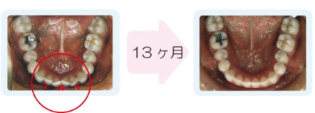 歯並び改善の臨床例